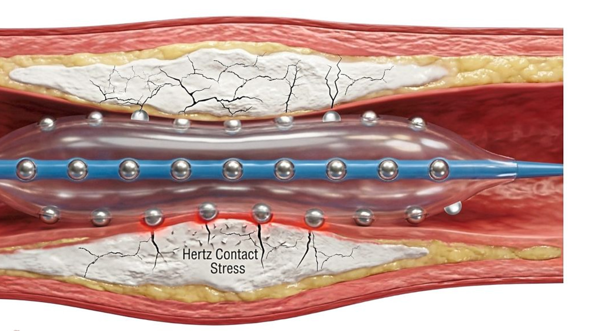 Malaysian cardiologists pioneer advanced heart plaque-cracking technology