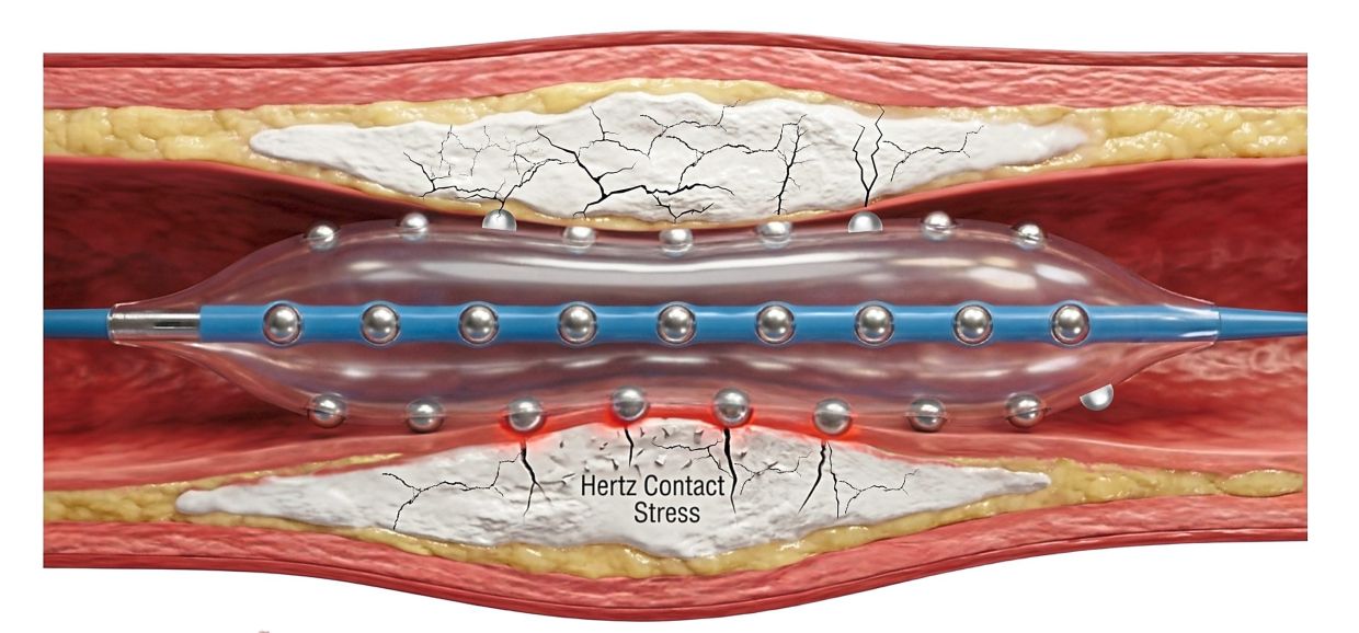 Malaysian cardiologists pioneer advanced heart plaque-cracking technology